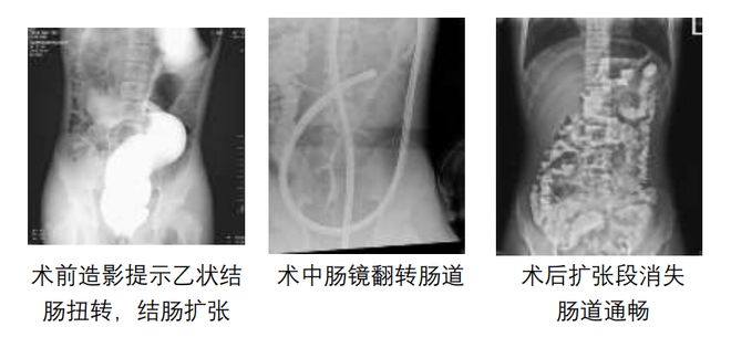 澳门新葡萄新京6663初三男孩体育课后突发腹痛居然是肠子“打了结”(图1)